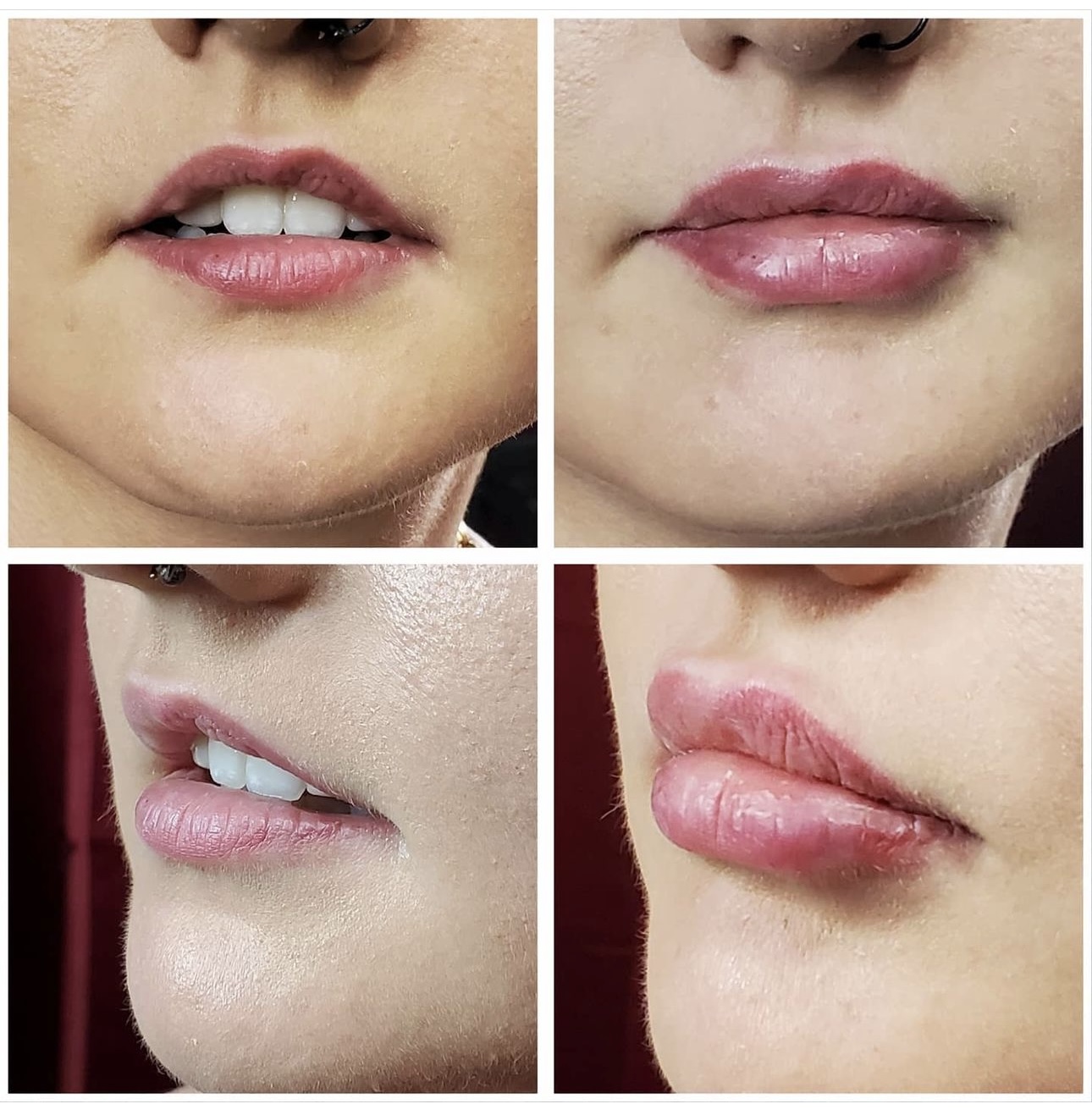 Before and after cosmetic treatment results